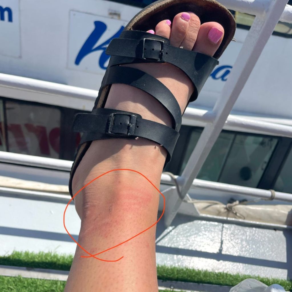 A foot in a birkenstock shoe on the railing of a boat with a circle drawn around their jellyfish sting from swimming in the sea near Malta